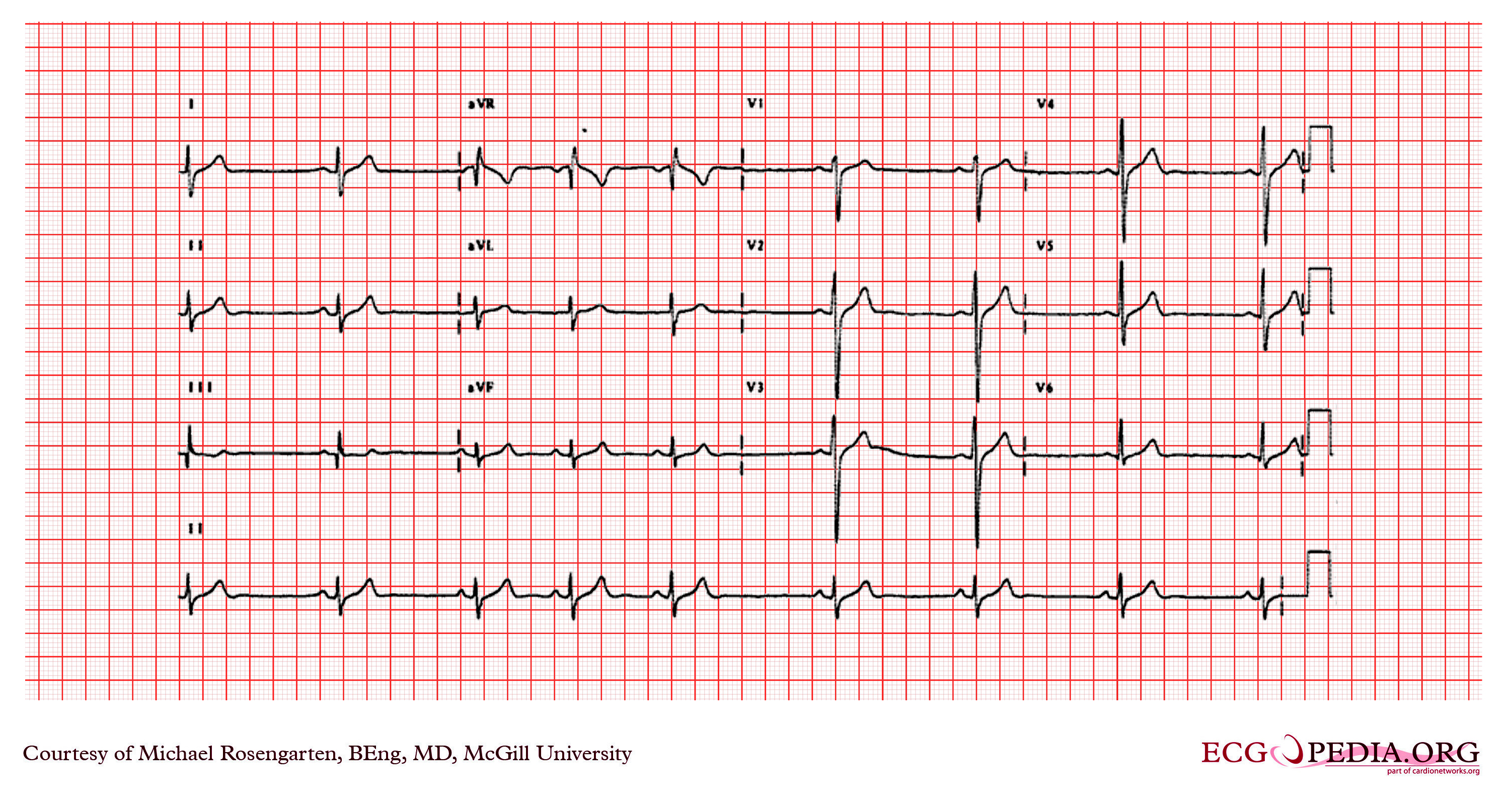 Right Ventricular Hypertrophy ECG