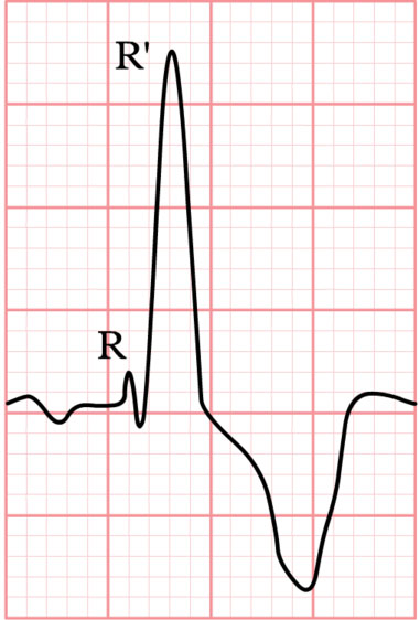 Right Bundle Branch Block