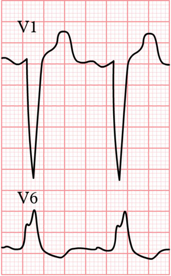 Left Bundle Branch Block