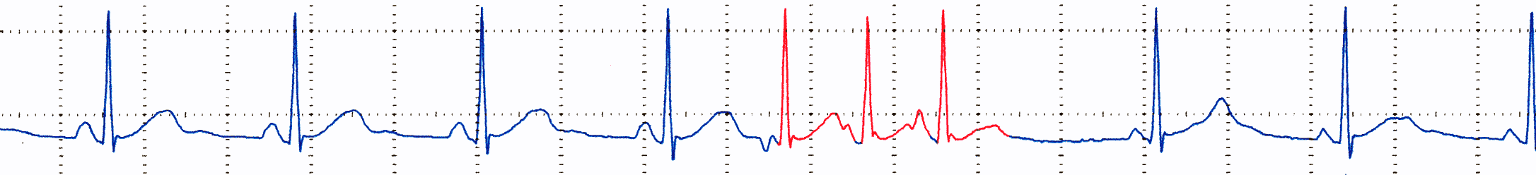Supraventricular Tachycardia