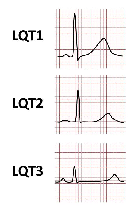 Long QT Subtypes