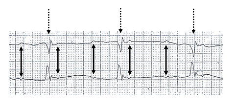 Complete Heart Block ECG