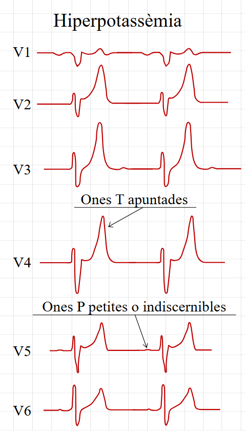 Hyperkalemia Progression