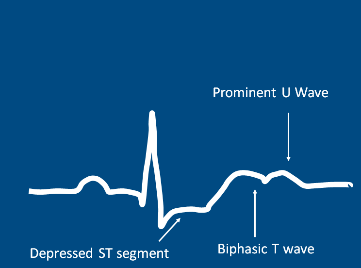 Hypokalemia ECG