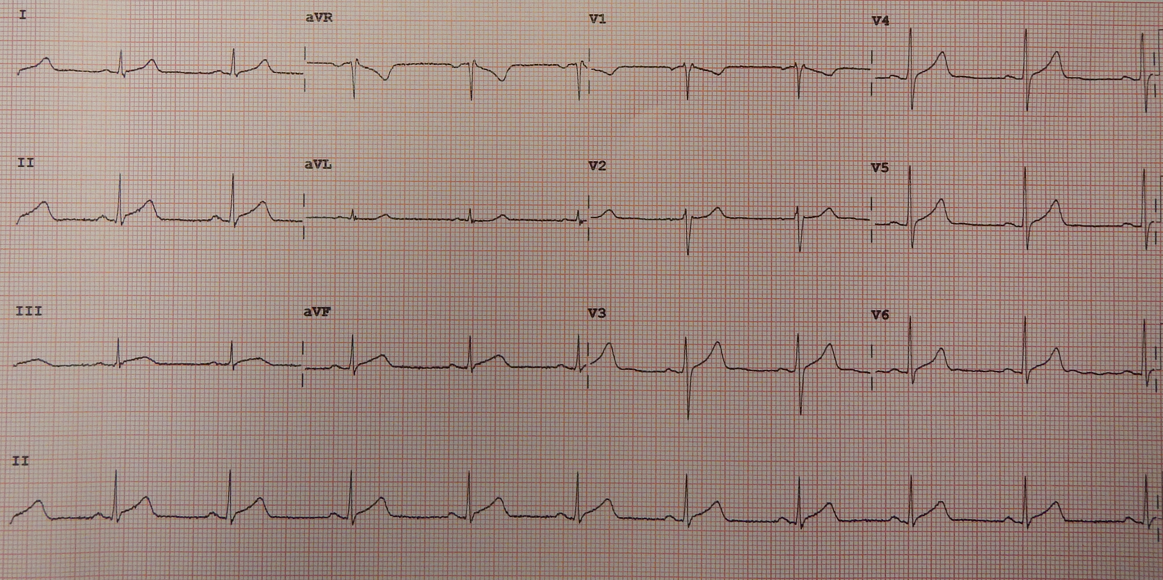 Acute Pericarditis ECG