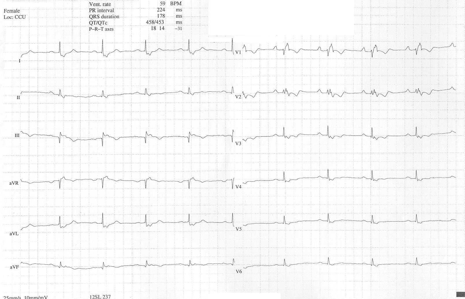 Ebstein Anomaly Clinical ECG