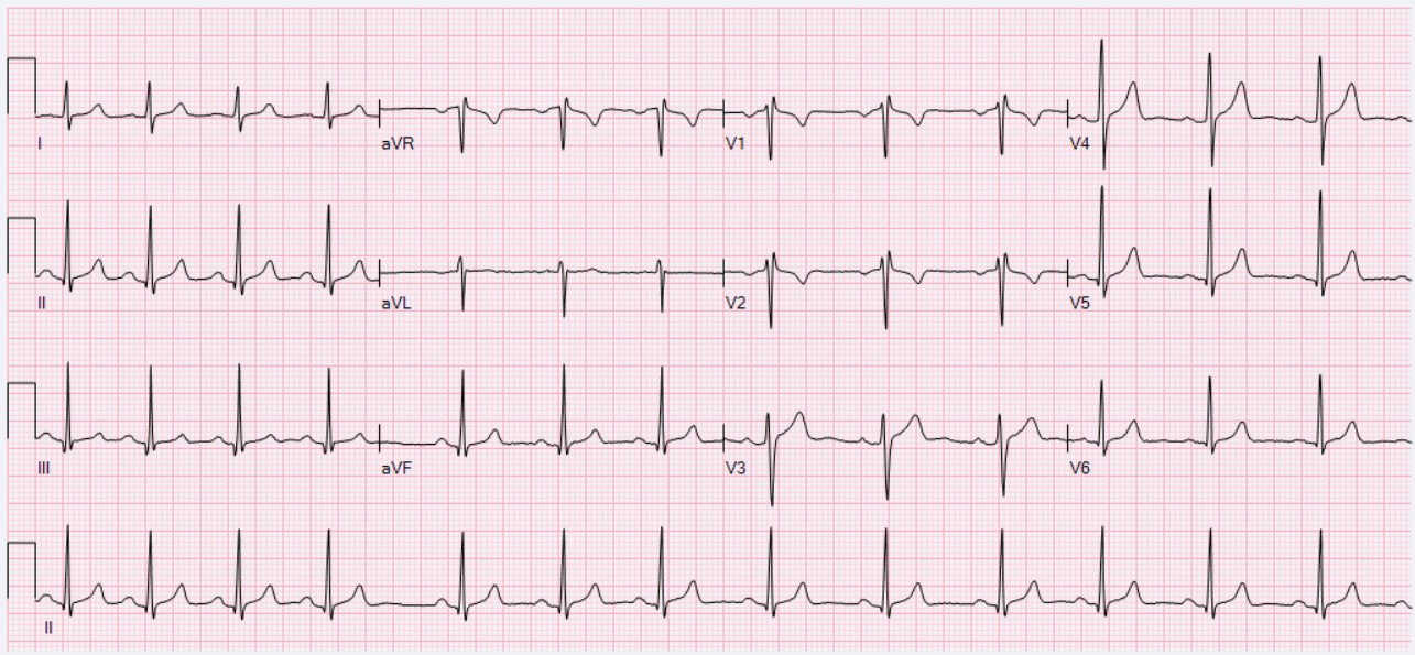 Pediatric Sinus Arrhythmia Tracing