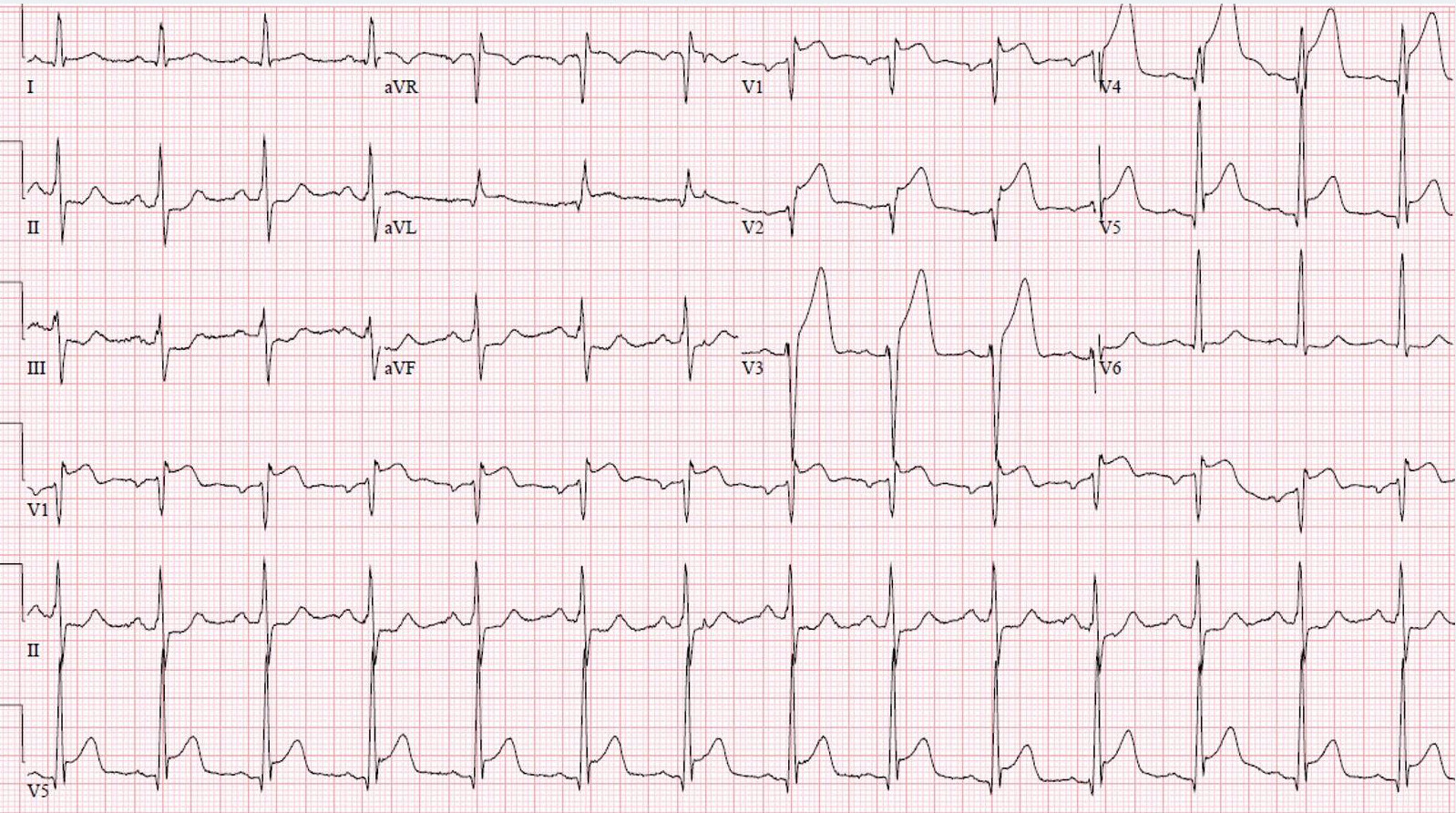 Acute Anterior STEMI