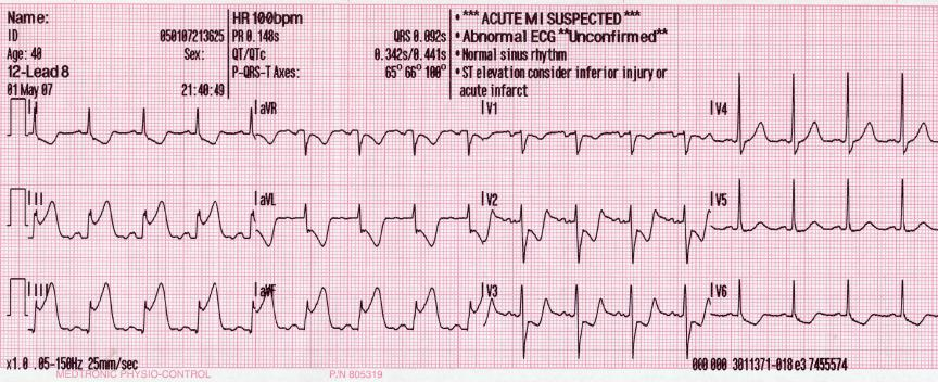 Acute Inferior STEMI