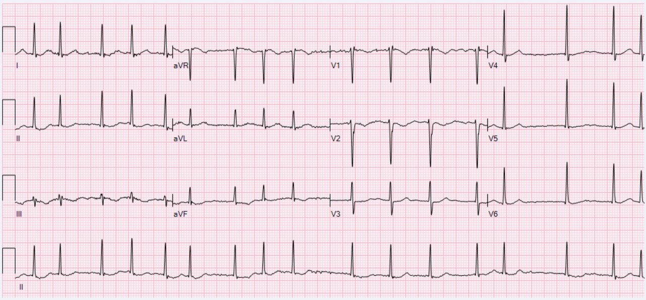 Atrial Fibrillation ECG