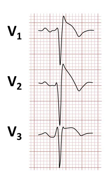 Brugada Syndrome