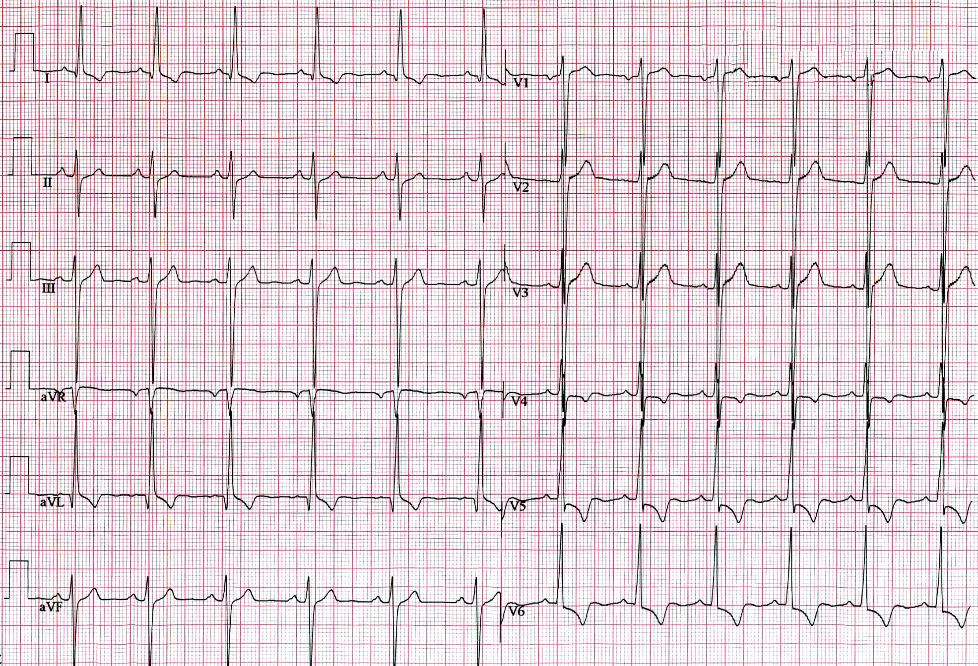 Hypertrophic Cardiomyopathy ECG