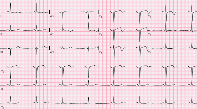 Wellens Syndrome ECG